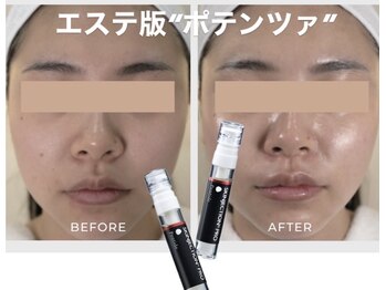 ナチュリー(Naturry)の写真/エステ版“ポテンツァ”でお肌にハリを。爆艶×水光肌が叶う「韓国艶肌管理」