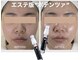 ナチュリー(Naturry)の写真/エステ版“ポテンツァ”でお肌にハリを。爆艶×水光肌が叶う「韓国艶肌管理」