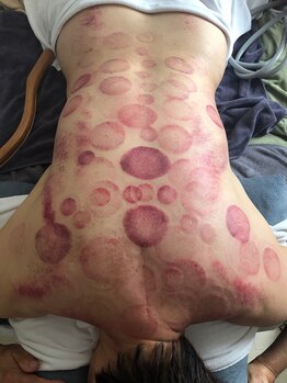 中国整体 らくらく堂/遠赤外線吸い玉+カッサ二回目