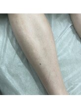 ナノハナ/鹿沼市の全身脱毛美容室ナノハナ