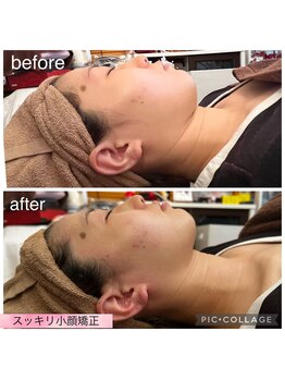 ベルダ(Beldad)/スッキリ小顔矯正