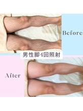 ソテ ボー(Sauter beau)/男性脱毛 脚4回施術