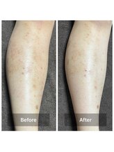 リノリー 古川店(rinory)/脱毛