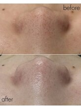 マーレ(MARE)/毛穴洗浄×ララピール