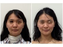 リシュレータ(RISYURE-TA)/美容鍼（before after）