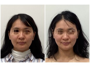 リシュレータ(RISYURE-TA)/美容鍼(before after)