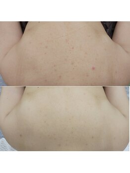 アンティクイーン(Antiqueen)/背中の黒ずみ!