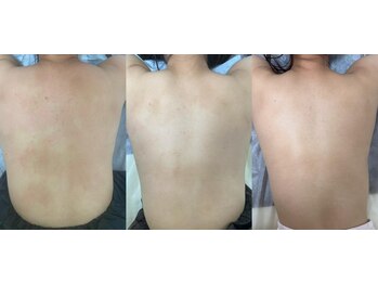 リベル 名古屋(Lebelle:)/ハーブピーリング専門 名古屋