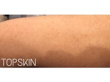トップスキン 新宿(TOPSKIN)/二の腕のぶつぶつ・ざらつき改善