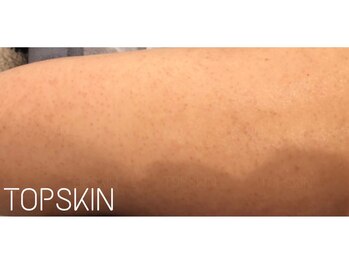 トップスキン 新宿(TOPSKIN)/二の腕のぶつぶつ・ざらつき改善