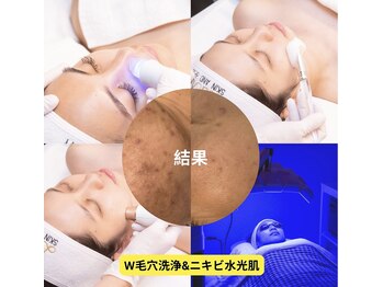 ラローズ(La Rose)の写真/人気のW毛穴洗浄xプラズマで黒ずみ・ニキビを集中
ケア！韓国風うるツヤ水光
肌へ