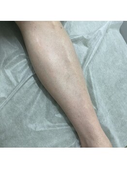 ナノハナ/鹿沼市の全身脱毛美容室ナノハナ