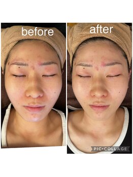 ベルダ(Beldad)/スッキリ小顔、肌質ケア