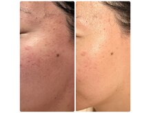 オレア(Olea)の雰囲気（乾燥しすぎて笑えなかった肌も、潤い溢れる肌へ！肌フローラケア）