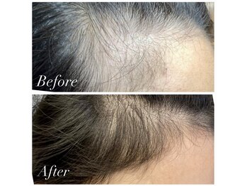 ジュエカフネ 広尾(JueCAFUNe)/本気の育毛促進ワンクール終了後