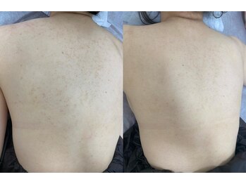 リベル 名古屋(Lebelle:)/ハーブピーリング専門 名古屋