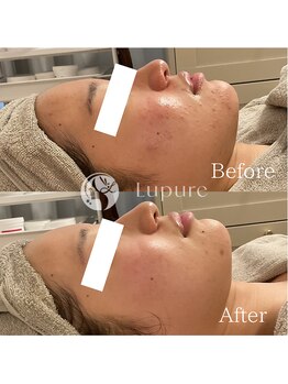ルプレ(Lupure)/ハーブピーリング12回目