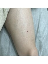 ナノハナ/鹿沼市の全身脱毛美容室ナノハナ