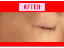 セブンシーズ 上野店(Seven Seas)/シミしわ改善！予防ケア/施術後