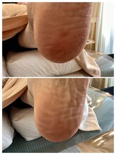 ドクターネイル爪革命 麻布十番店/【角質ケア】フットケア