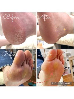 気になる足裏がつるつるに☆