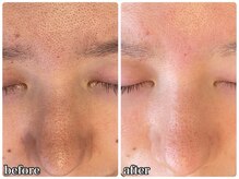 リミー 東大宮店(REME)/【ハイドラ】毛穴の汚れケア