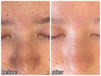 リミー 東大宮店(REME)/【ハイドラ】毛穴の汚れケア