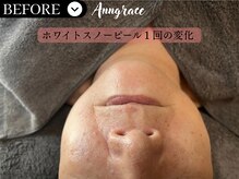 アングレイス(Anngrace)/【本気の肌質改善】圧倒的効果