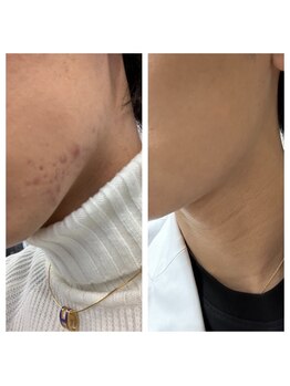 Beauty salon Ren/ハーブピーリング