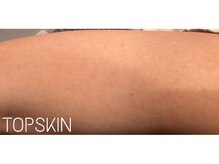 トップスキン 新宿(TOPSKIN)/二の腕のぶつぶつ・ざらつき改善