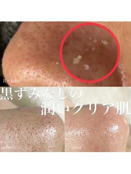アールプラスラボ(R+labo)/角質や過剰皮脂による詰まり！