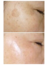 ヌー 栄(nuu)&nbsp;シミケア 専門