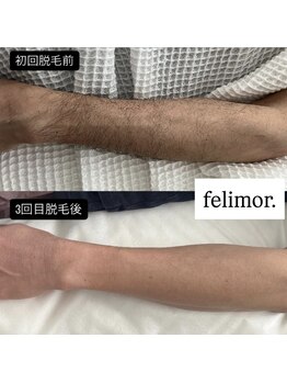 フェリモール(Felimor.)/メンズ脱毛