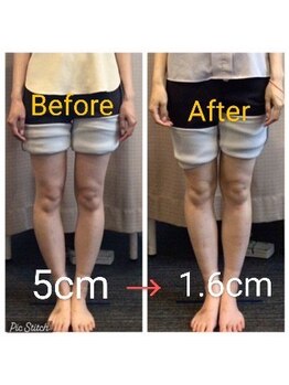 クシロ鍼灸整骨院/【O脚矯正】施術例