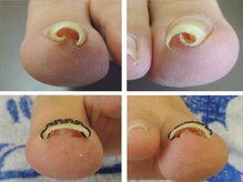 フットプロ 上田/巻き爪