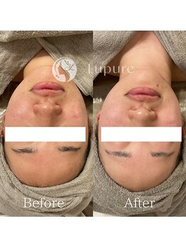 ルプレ(Lupure)/ハーブピーリング12回目