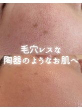 リルビー(Lilby)/毛穴ケア・ハーブピーリング