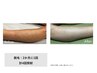 【メンズ】脇+髭脱毛¥6.500