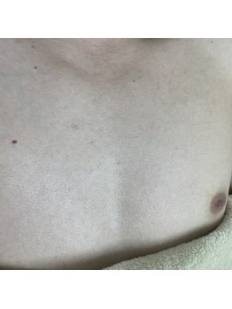 ナノハナ/鹿沼市の全身脱毛美容室ナノハナ