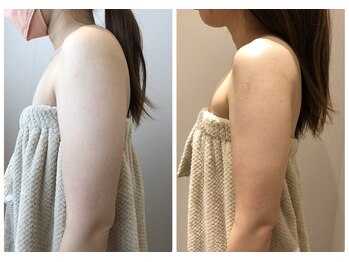 エイシスグロウ(asis glow.)/効果写真