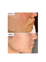 アエ(ae)/アクネケア、赤みにも◎