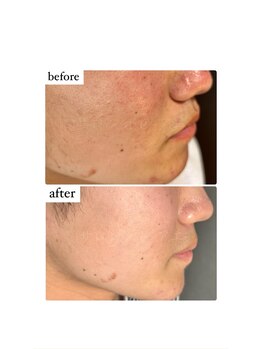 アエ(ae)/アクネケア、赤みにも◎