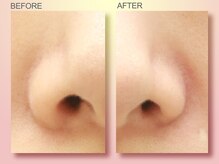 ジュリア オージェ 難波店/ビフォーアフター（鼻スパ）