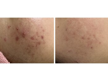 メルシア(merucia)/跡、ニキビケア、赤み改善