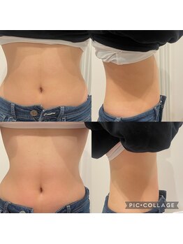 ルナート(Lunart)/腸もみの一回の変化