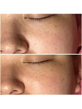 リンク(LiNK)/ハーブピーリング