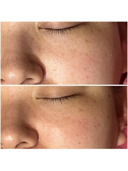 リンク(LiNK)/ハーブピーリング