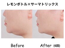 ラディアント たまプラーザ/レモンボトル×サーマトリックス