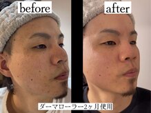 りかり 明石大久保院/ホームケアで肌質改善！！