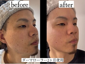 りかり 明石大久保院/ホームケアで肌質改善!!